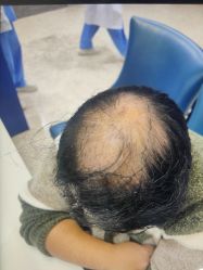 -大麦微针植发全国连锁