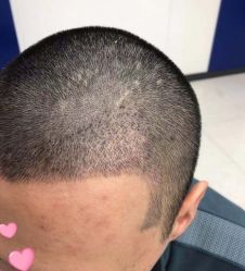 -大麦微针植发丨全国连锁