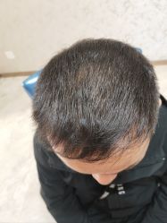 -大麦微针植发丨全国连锁