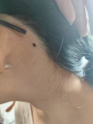 -北京美痣堂古方祛痣斑疣瘊