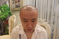 点击看大图 -大麦微针植发丨全国连锁