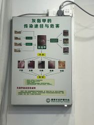 -德哥灰指甲脚气甲沟炎跖疣护理