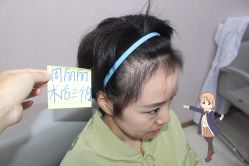 -大麦微针植发丨全国连锁