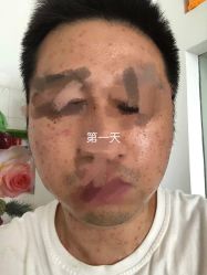 -爱莎扁平疣·汗管瘤·斑痣中心