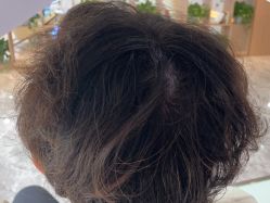 -碧莲盛·不剃发植发