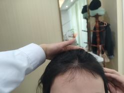 -碧莲盛·不剃发植发