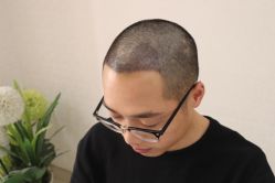 -大麦微针植发丨全国连锁