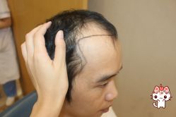 -大麦微针植发丨全国连锁