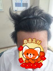 -大麦微针植发丨全国连锁