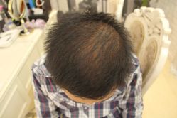 点击看大图 -大麦微针植发丨全国连锁