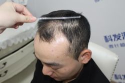 -大麦微针植发丨全国连锁