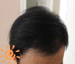 -大麦微针植发丨全国连锁