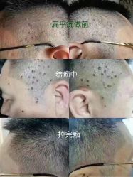 -爱莎扁平疣·汗管瘤·斑痣中心