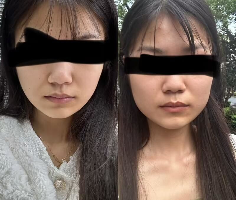 瘦脸针and下颌缘