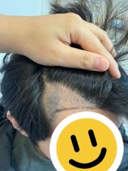 -大麦微针植发全国连锁