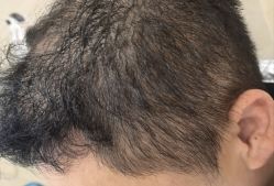 -碧莲盛·不剃发植发