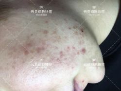 -云贝细胞祛痘痘印