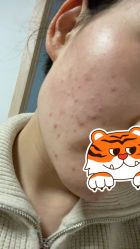 点击看大图 -友仟痘医生科学祛痘连锁