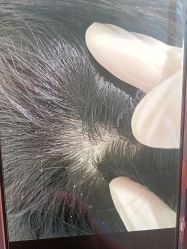 -碧莲盛·不剃发植发