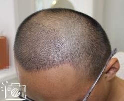 -大麦微针植发丨全国连锁