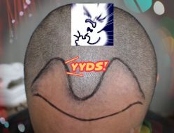 -大麦微针植发全国连锁