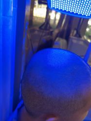 -碧莲盛·不剃发植发