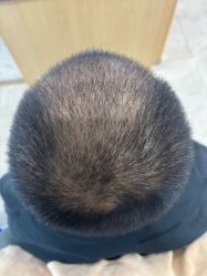 -大麦微针植发丨全国连锁