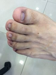 -德哥灰指甲脚气甲沟炎跖疣护理