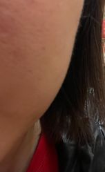 点击看大图 体验后-CMS西美斯·美式医疗美容