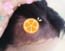 -大麦微针植发全国连锁