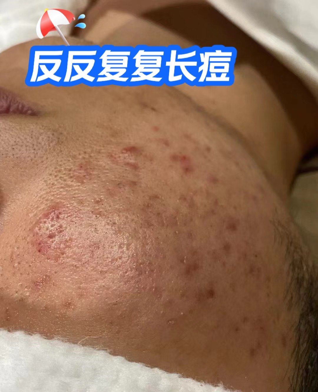 囊肿型痤疮是怎么演变而来