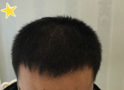 -大麦微针植发丨全国连锁