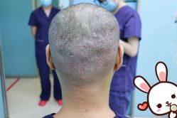 点击看大图 -大麦微针植发丨全国连锁