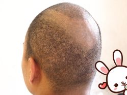 点击看大图 -大麦微针植发丨全国连锁