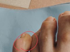 -世龙世家灰指甲鸡眼脚气甲沟炎跖疣护理(通州店)