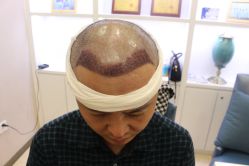 -大麦微针植发丨全国连锁