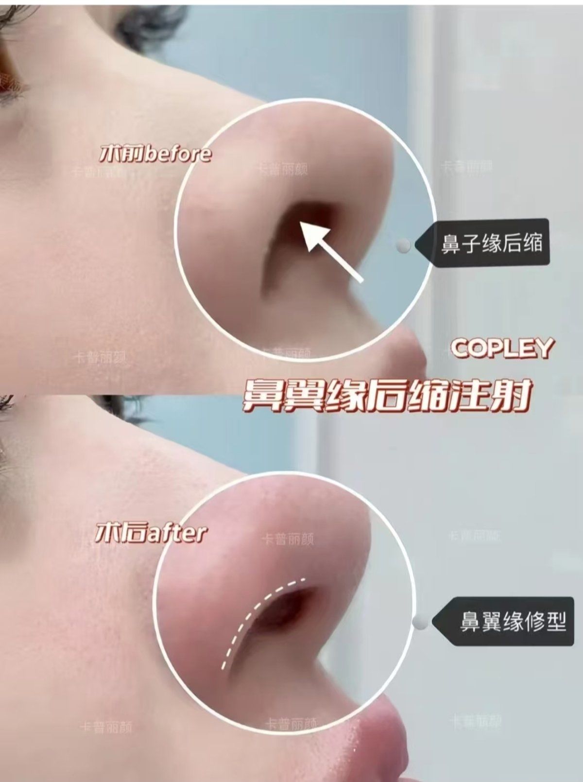鼻翼