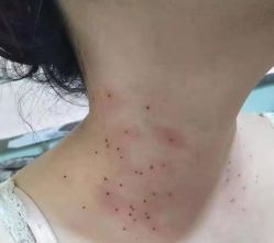 -北京美痣堂古方祛痣斑疣瘊