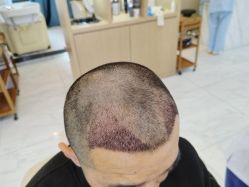 点击看大图 -大麦微针植发丨全国连锁