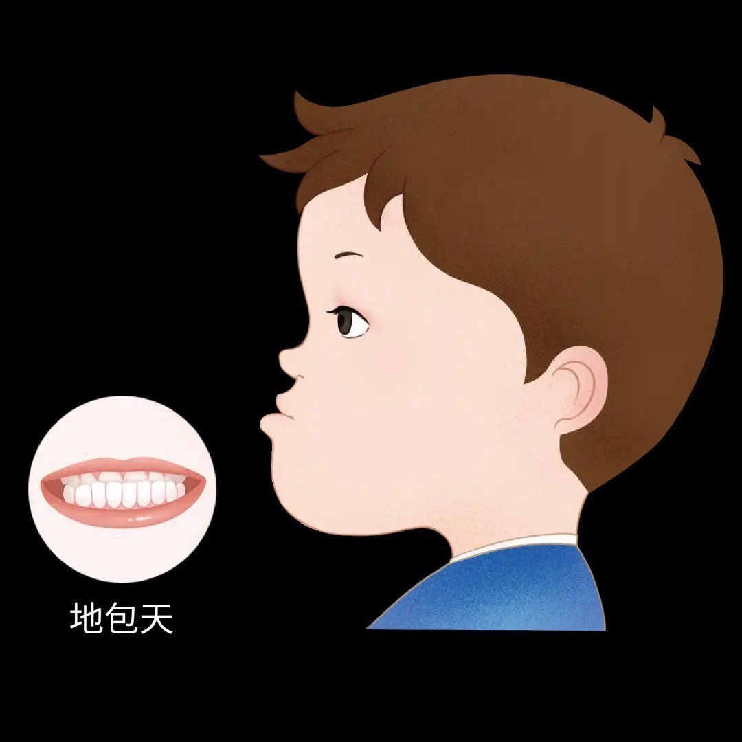 "地包天"不可怕,预防是关键!