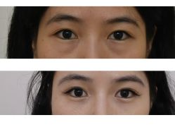 -广州健丽·去眼袋医疗美容机构