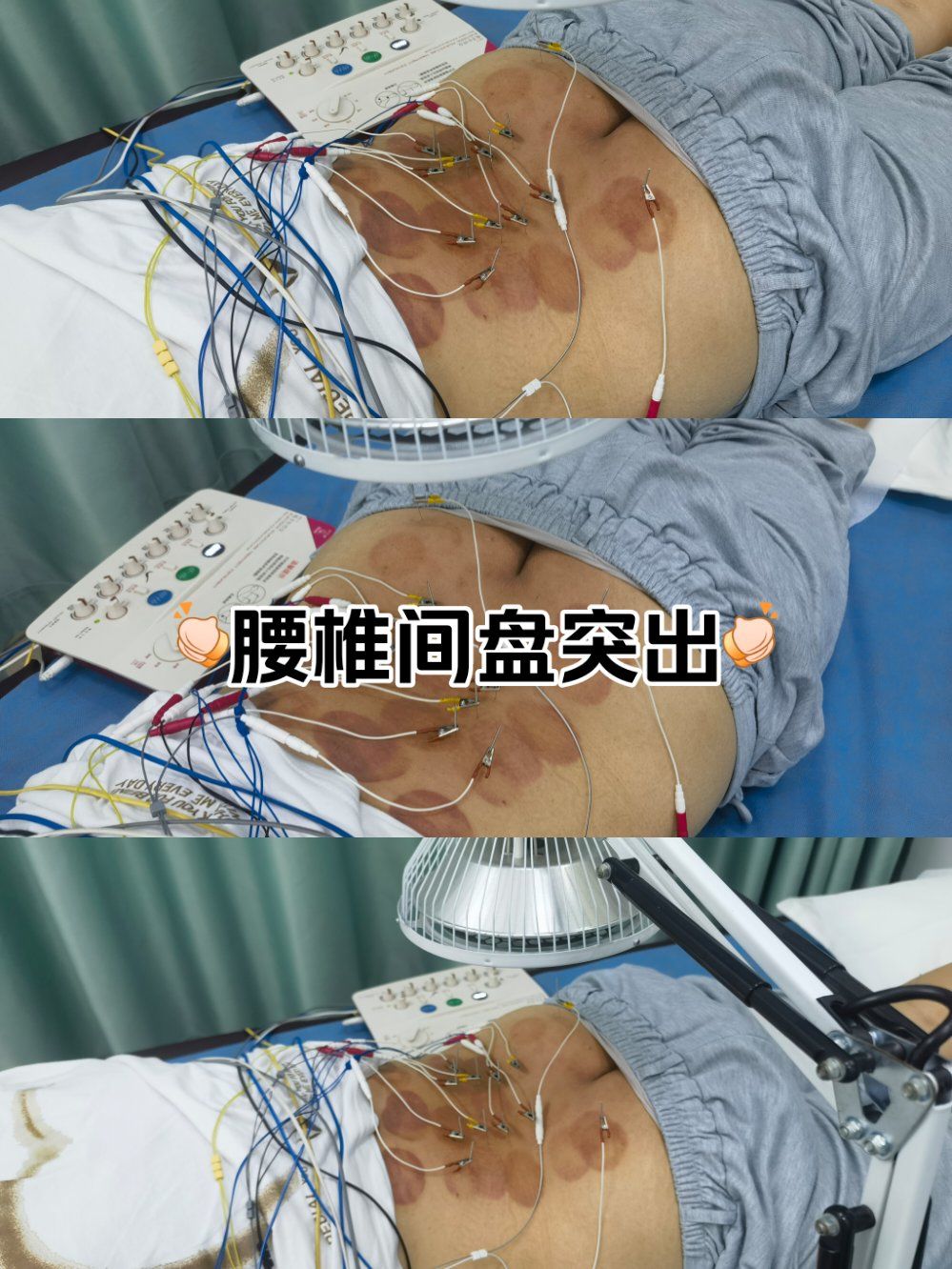 是的,腰椎间盘突出最好的治疗就是针灸,推拿复位#中医养生#推拿#中医