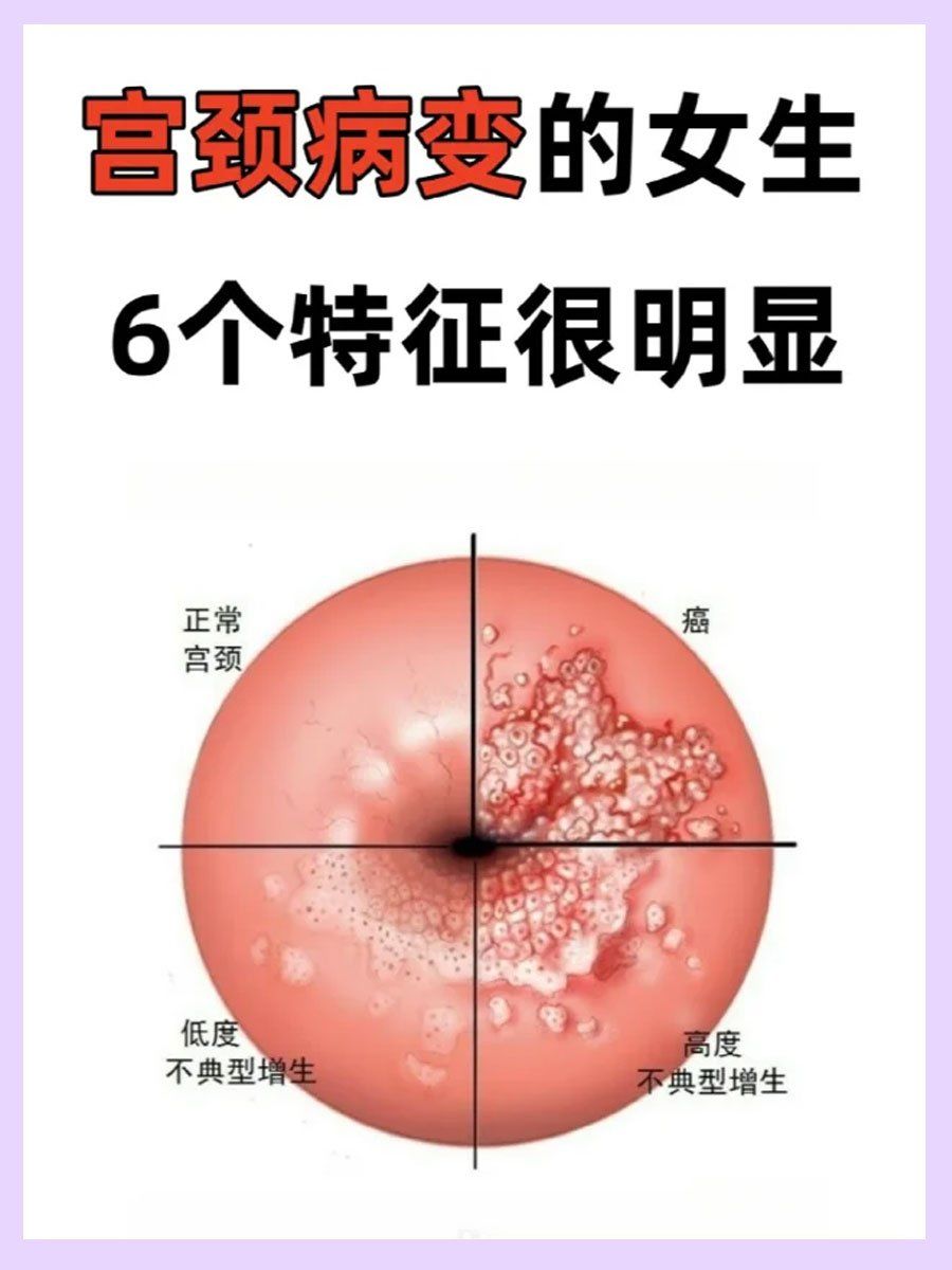 hpv感染6大特征!宫颈病变及时注意!