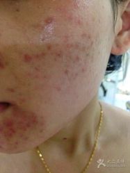 -苗方清颜专业祛痘