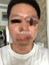 -爱莎扁平疣·汗管瘤·斑痣中心