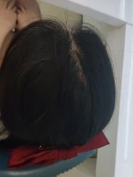 -大麦微针植发丨全国连锁