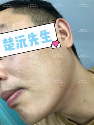 -楚沅先生专业男士脱毛连锁