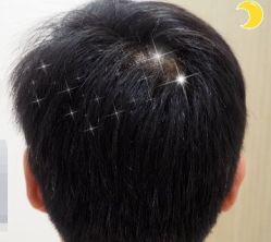 -大麦微针植发丨全国连锁