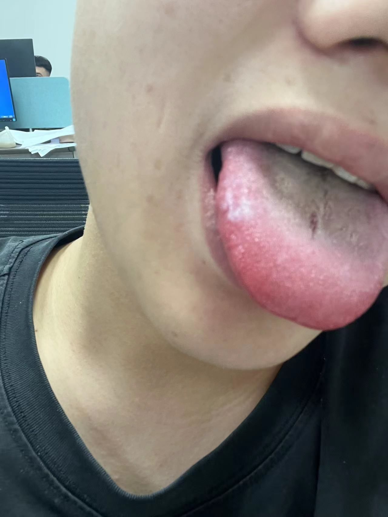 口腔扁平苔藓白斑