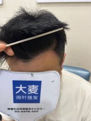 体验后-大麦微针植发丨全国连锁